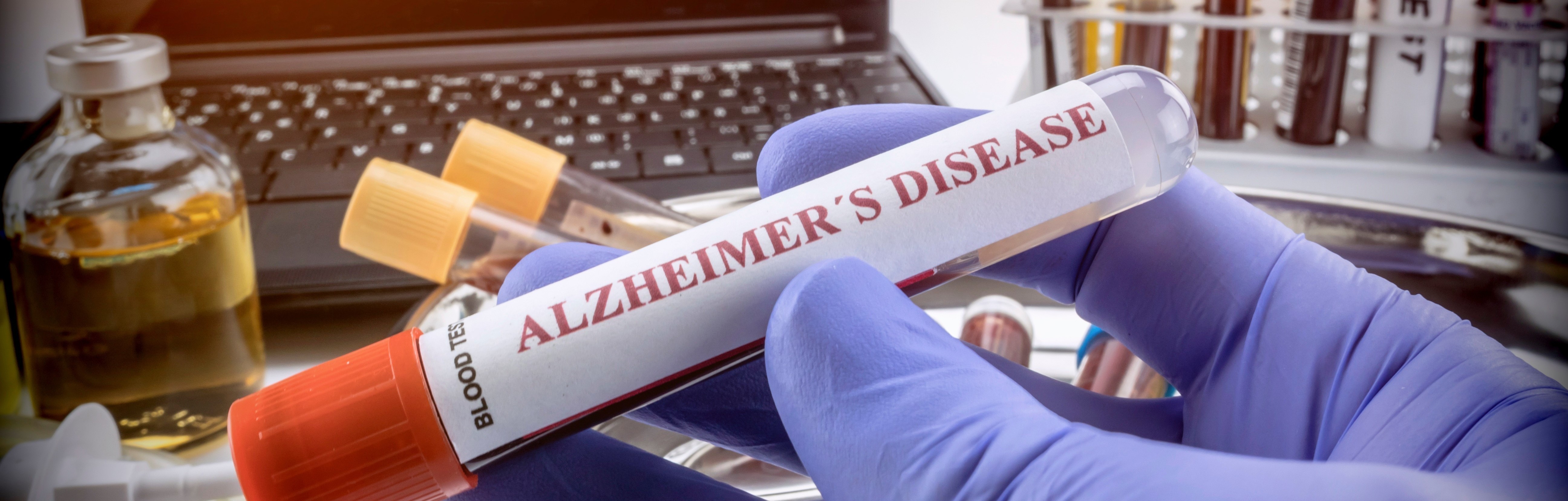 Alzheimer