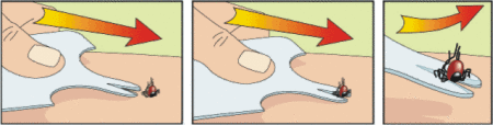 Drei Illustrationen zeigen die richtige Entfernung einer Zecke: 1. Eine Hand hält eine Zeckenzange über einer Zecke. 2. Die Zange wird angehoben. 3. Die Zecke wird vollständig entfernt.