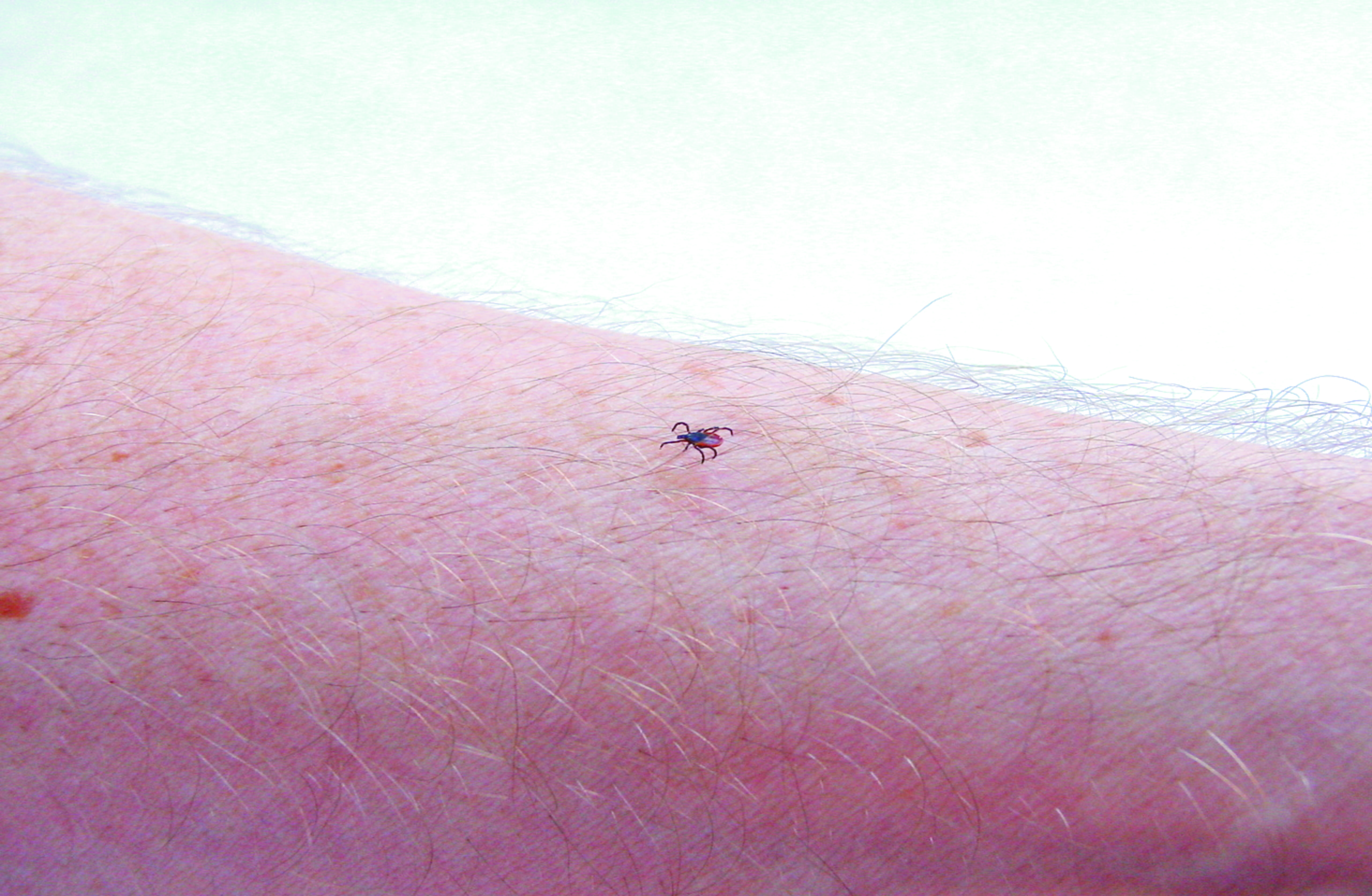 Zecke sitzt auf einem menschlichen Arm